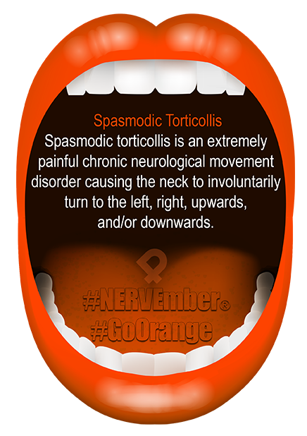 Spasmodic Torticollis NERVEmber GoOrange iPain Spasmodic Torticollis NERVEmber GoOrange iPain